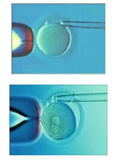 羊水穿刺术的临床应用